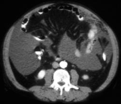 Linitis Plastica and Carcinomatosis - CTisus CT Scan