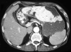 Delayed Gastric Emptying - CTisus CT Scan