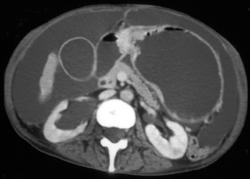 Antral Cancer and Carcinomatosis - CTisus CT Scan