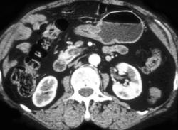 Antral Cancer - CTisus CT Scan