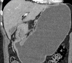 Gastric Adenocarcinoma - CTisus CT Scan