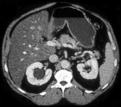 Normal Stomach With Simulated Tumor Due to Collapse - CTisus CT Scan