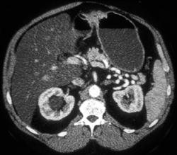 Antral Carcinoma - CTisus CT Scan