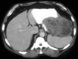 GIST Tumor - CTisus CT Scan