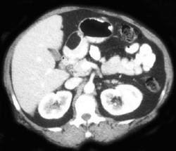 Gastric Lipoma - CTisus CT Scan