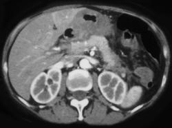 Linitis Plastica - CTisus CT Scan