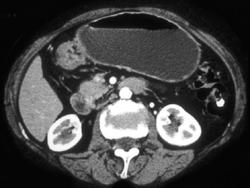 Antral Carcinoma - CTisus CT Scan