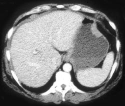 Gastric Adenocarcinoma - CTisus CT Scan