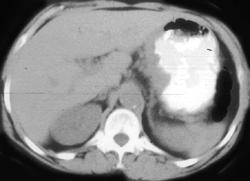 Gastric Adenocarcinoma - CTisus CT Scan