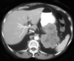 GIST Tumor - CTisus CT Scan