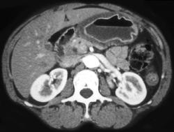 Gastric Adenocarcinoma - CTisus CT Scan