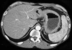 Linitis Plastica - CTisus CT Scan