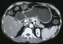 Pancreatic Cancer Causes Gastric Outlet Obstruction - CTisus CT Scan