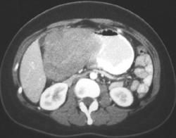 GIST Tumor - CTisus CT Scan