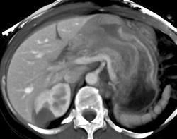 Linitis Plastica - CTisus CT Scan