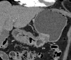 Antral Carcinoma - CTisus CT Scan