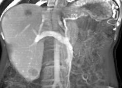 Gastric Varices Due to Splenic Vein Occlusion With Collaterals - CTisus CT Scan