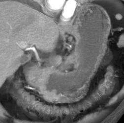 Antral Carcinoma - CTisus CT Scan