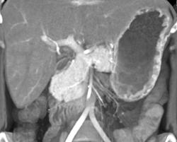 Normal Gastric Folds - CTisus CT Scan