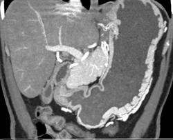 Normal Gastric Folds - CTisus CT Scan