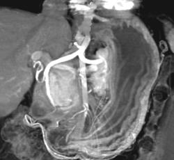 Normal Gastric Folds - CTisus CT Scan