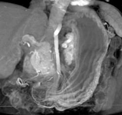 Normal Gastric Folds - CTisus CT Scan