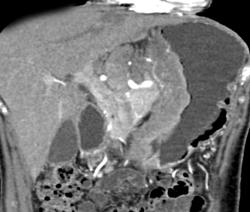 Gastric Adenocarcinoma With Celiac Adenopathy - CTisus CT Scan