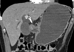 Antral Carcinoma - CTisus CT Scan