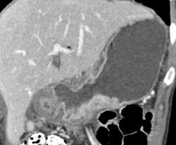 Antral Carcinoma - CTisus CT Scan