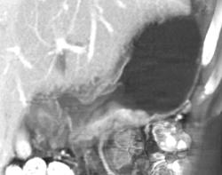 Antral Carcinoma - CTisus CT Scan