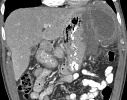 GIST Tumor of the Stomach - CTisus CT Scan