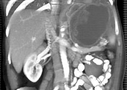 GIST Tumor - CTisus CT Scan