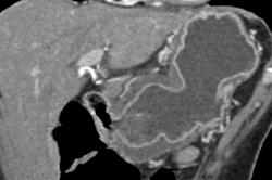 Infiltrating Adenocarcinoma - CTisus CT Scan