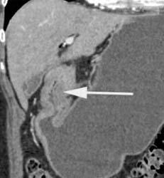 Antral Carcinoma - CTisus CT Scan