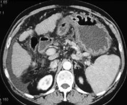 Gastritis - CTisus CT Scan