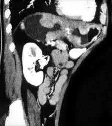 Gastric Cancer - CTisus CT Scan