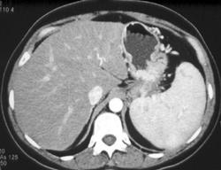 Gastric Cancer in Fundus - CTisus CT Scan