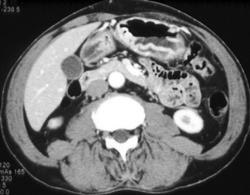 Gastritis - CTisus CT Scan