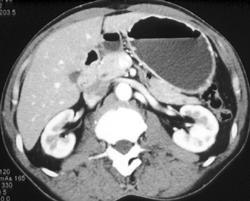 Normal Stomach - CTisus CT Scan