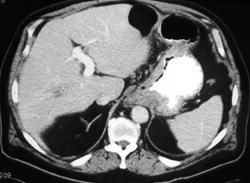 Gastric Cancer With Portocaval Nodes - CTisus CT Scan