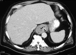 Gastric Cancer Extends to Gastroesophageal (GE) Junction - CTisus CT Scan