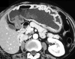 Gastritis - CTisus CT Scan