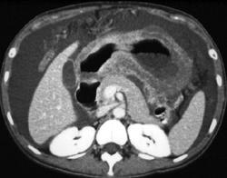 Linitis Plastica - CTisus CT Scan