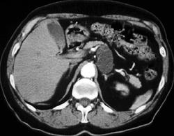 Gastric Duplication Cyst - CTisus CT Scan