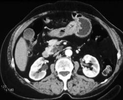 Antral Gastritis Simulates Gastric Cancer - CTisus CT Scan