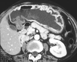 Gastritis - CTisus CT Scan