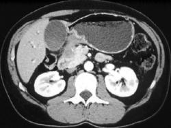 Recurrent Gastric Cancer With Obstructed Bile Ducts - CTisus CT Scan