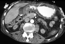 Antral Gastritis S/P Radiation - CTisus CT Scan