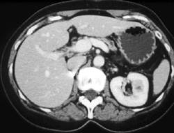 Normal Stomach - CTisus CT Scan