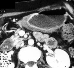 B-cell Lymphoma - CTisus CT Scan